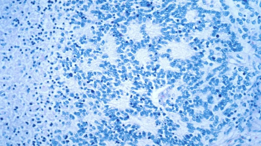 This December 1993 microscope photo provided by the National Cancer Institute shows a typical neuroblastoma with rosette formation. In a study published Wednesday, April 5, 2023, in the New England Journal of Medicine, a novel treatment, CAR-T cell therapy, using supercharged immune cells, appears to work against tumors in children with the rare kind of cancer. (Dr. Maria Tsokos/National Cancer Institute via AP)