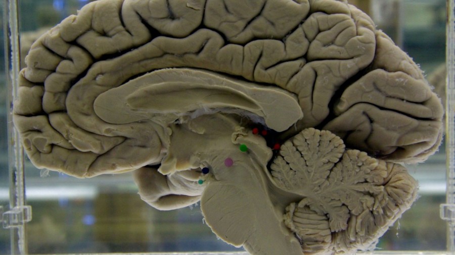 This Tuesday, Oct. 7, 2003 file photo shows a section of a preserved human brain on display at the Museum of Neuroanatomy at the University at Buffalo, in Buffalo, N.Y. A study released on Tuesday, April 10, 2018 offers more evidence of a link between traumatic brain injuries and dementia later in life, with repeated injuries and severe ones posing the greatest danger. (AP Photo/David Duprey)