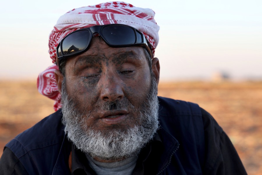 Ali Mansour, 43, who lost his eyes and hands to a cluster bomb in 2019, poses for a photograph at a camp in Idlib province, Syria, on July 19, 2023. More than 300 people were killed by cluster munitions in Ukraine in 2022, according to an international watchdog, displacing Syria as the country with the highest number of deaths from the controversial weapons for the first time in a decade. (AP Photo/Omar Albam)