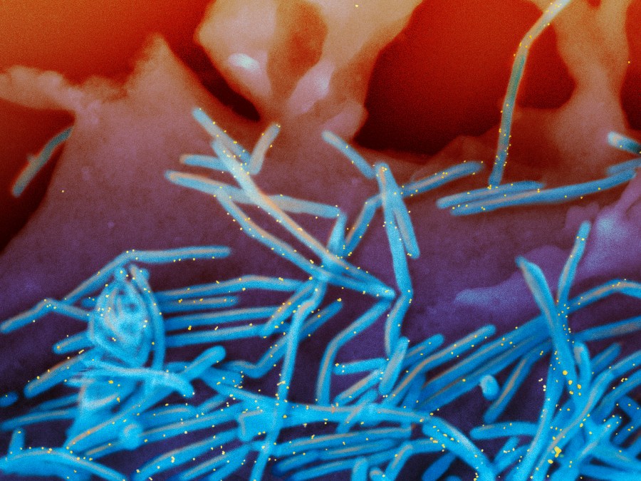 FILE - This electron microscope image provided by the National Institutes of Health shows human respiratory syncytial virus (RSV) virions, colorized blue, and anti-RSV F protein/gold antibodies, colorized yellow, shedding from the surface of human lung cells. In a report released Thursday, May 30, 2024, the Centers for Disease Control and Prevention said they are continuing to investigate a link between two new RSV vaccines and cases of a rare nervous system disorder in older U.S. adults. (National Institute of Allergy and Infectious Diseases, NIH via AP, File)